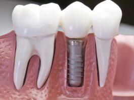 Стоматология: имплантация зубов