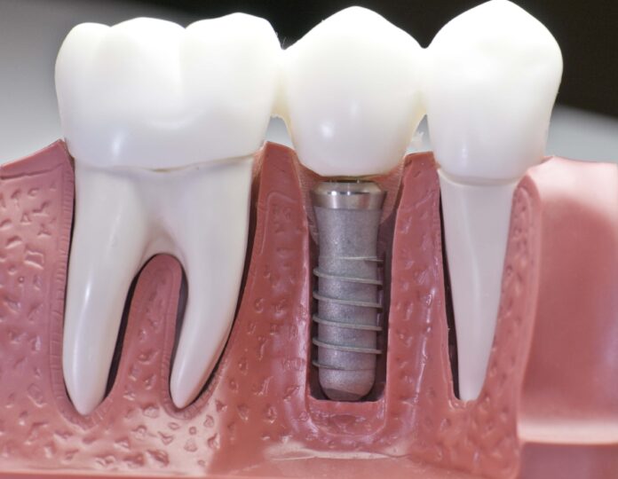 Стоматология: имплантация зубов