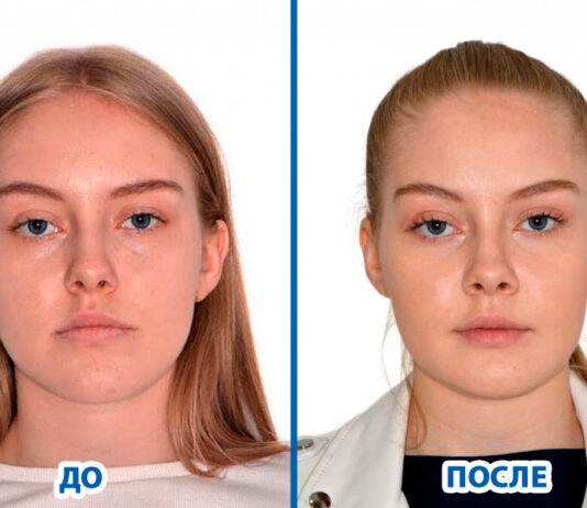 гениопластика