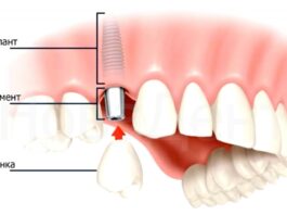 Что такое зубные импланты?