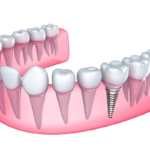 implantaciya-zubov-v-moskve