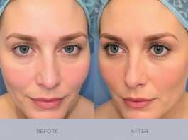 Пластическая хирургия без страха: всё о блефаропластике и ринопластике