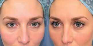 Пластическая хирургия без страха: всё о блефаропластике и ринопластике