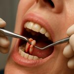 Удаление зубов: когда это нужно и как пройти через это без страха