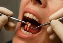 Удаление зубов: когда это нужно и как пройти через это без страха