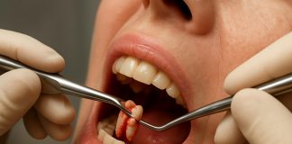Удаление зубов: когда это нужно и как пройти через это без страха