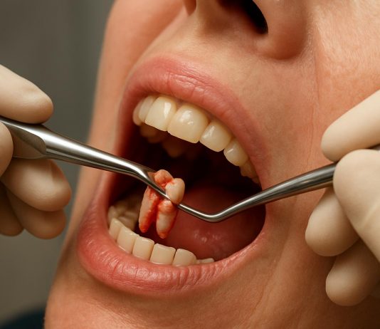 Удаление зубов: когда это нужно и как пройти через это без страха