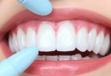 Виниры для зубов: что это такое и как не ошибиться с выбором