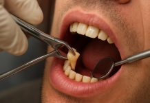 Удаление зуба: что нужно знать, чтобы пройти процедуру спокойно и без сюрпризов