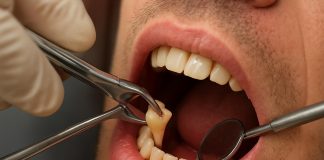Удаление зуба: что нужно знать, чтобы пройти процедуру спокойно и без сюрпризов